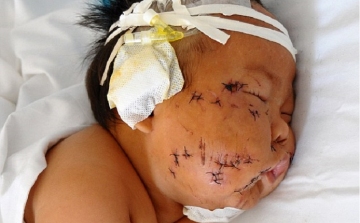 90 szúrást ejtett nyolc hónapos csecsemőjén a kínai anya